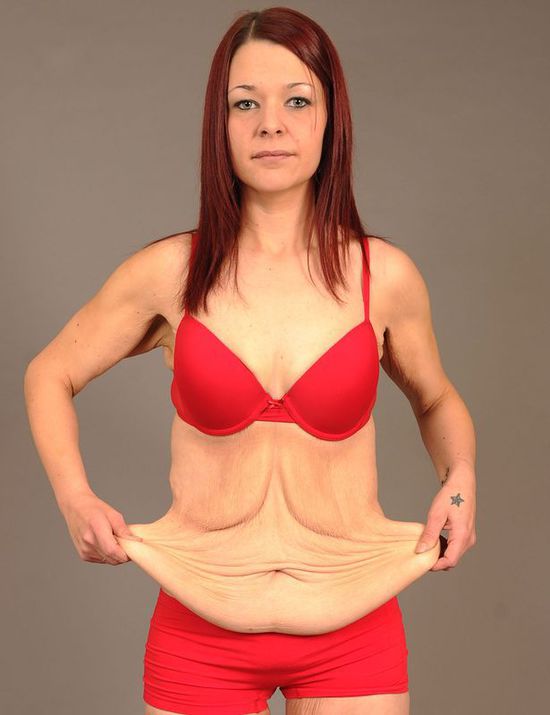 英女子为婚礼狂减114斤致皮肤松垮如老妇