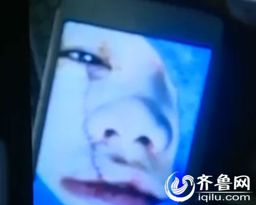 小刘脸部被毁容，右脸有一道从眼角到嘴唇的伤口。（视频截图）