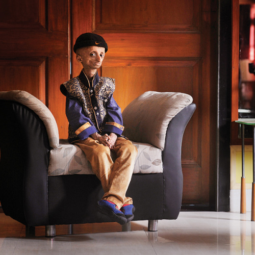 未老先衰：印度14岁男孩患早衰症体重仅为25斤