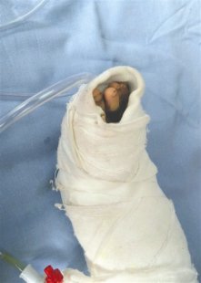 <b>四川巴中10多名小学生被罚光脚跑步遭烫伤（图）</b>