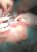 <b>脐带绕颈达7圈 这个宝宝真不易</b>