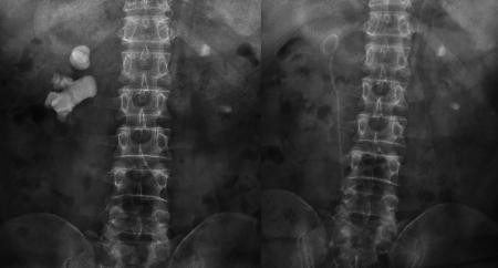 宋先生术前与第二次术后的结石对比