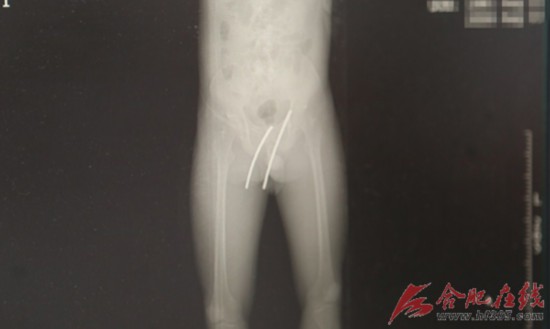 CT显示钢筋所在的位置