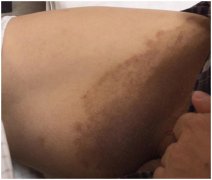 男子患肾病竟然脚气惹的!