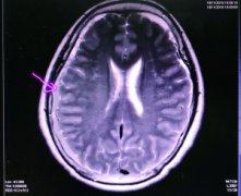 无锡一女子脑袋“漏水” 导致头疼难忍