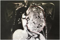 <b>31岁妈妈胸腔内肿瘤长26厘米医生用手“摸除”</b>